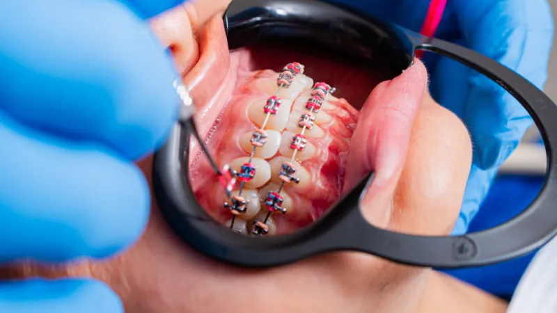 A close-up of braces fitted on a patient's teeth