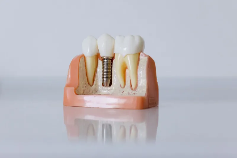 A dental implant model showing an implant between natural teeth
