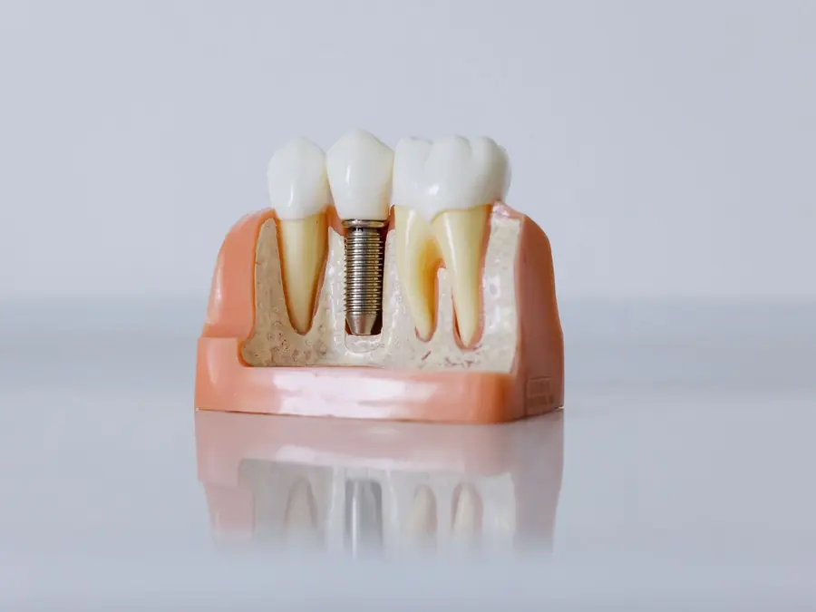 A model of a dental implant fixture supporting a crown, alongside two natural teeth in bone