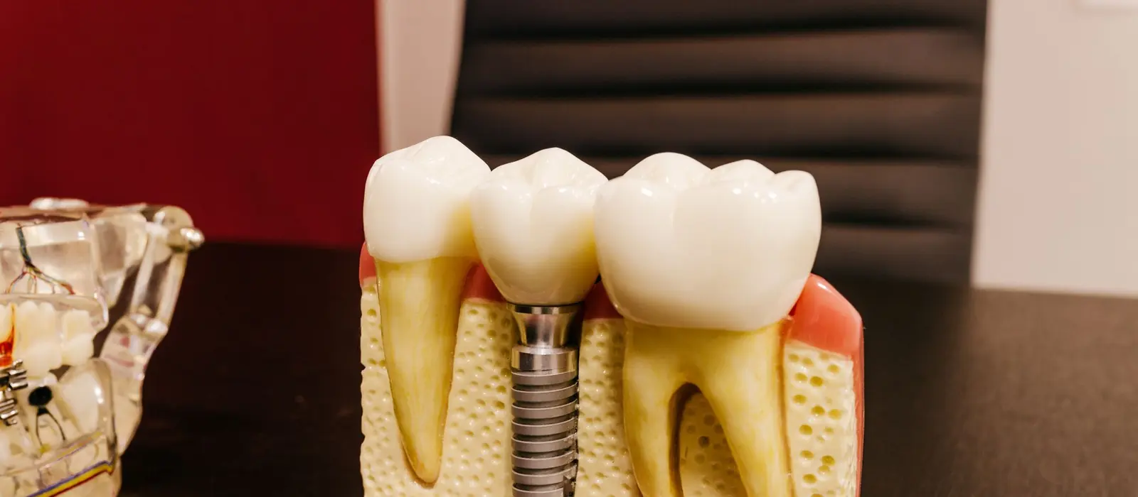 A cutaway model showing a titanium dental implant in the jawbone between two natural teeth