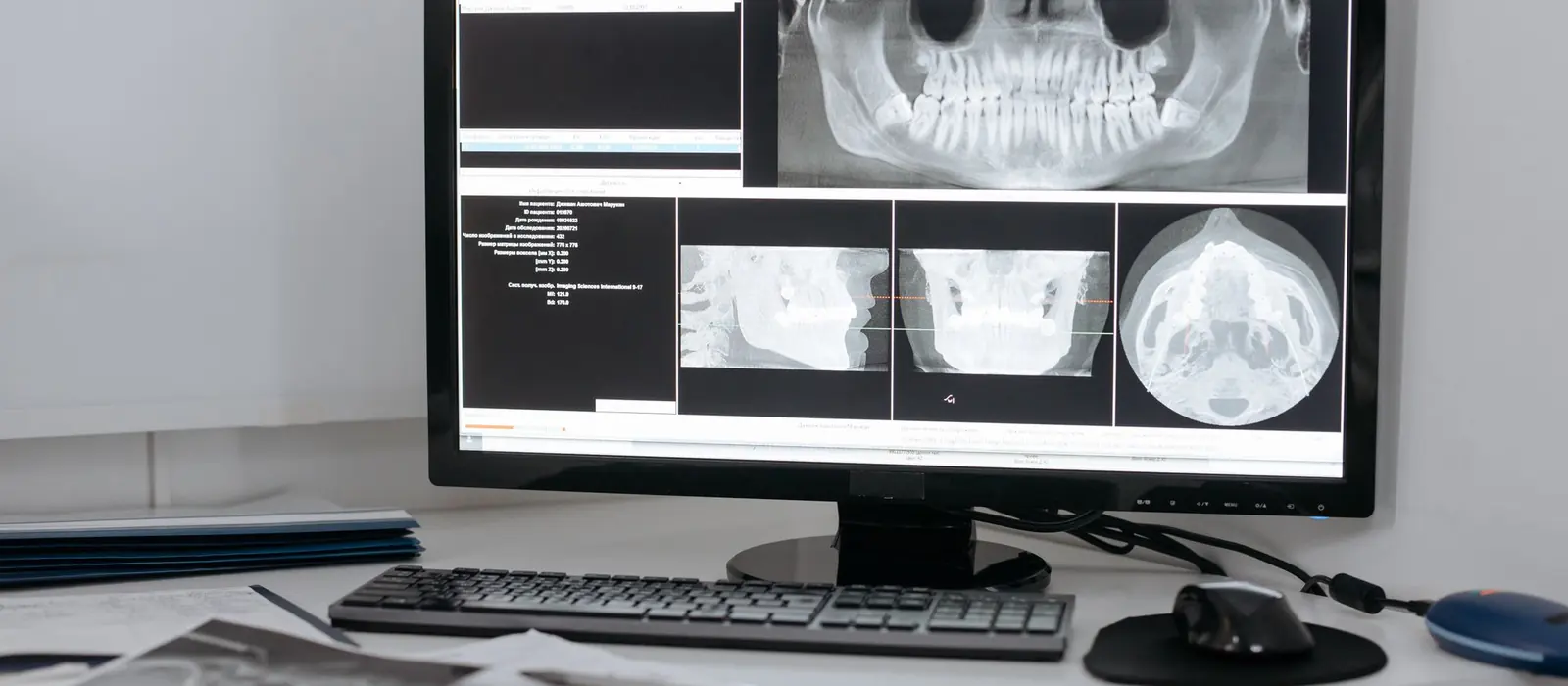 A dental X-ray of the jaws displayed on a clinic monitor